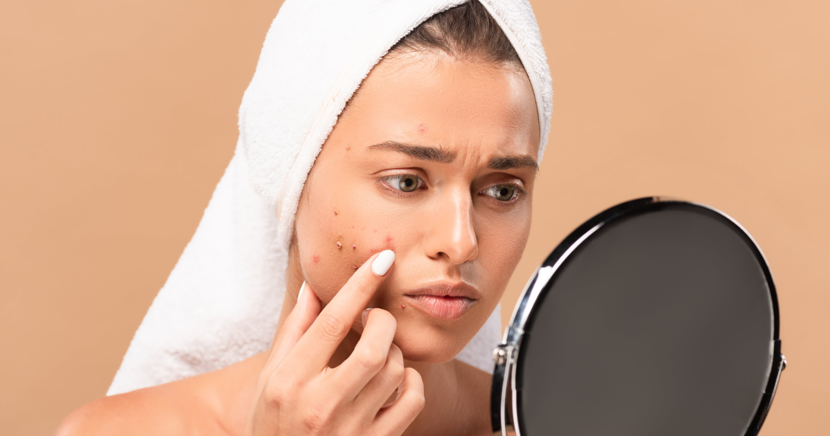 5 Reasons to Consider IPL for Stubborn Acne and Redness